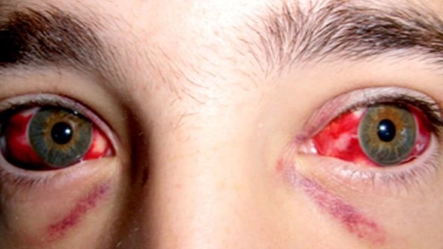 NUEVO CASO DE FIEBRE HEMORRÁGICA EN ESPAÑA