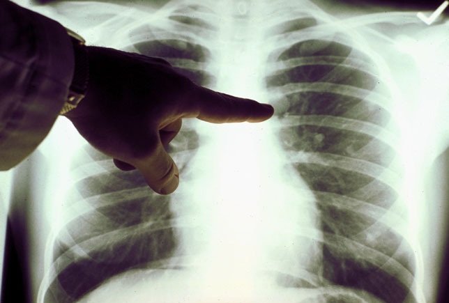 DESARROLLAN UN MÉTODO DIAGNÓSTICO DE LA PREDISPOSICIÓN A LA NEOPLASIA DE PULMÓN