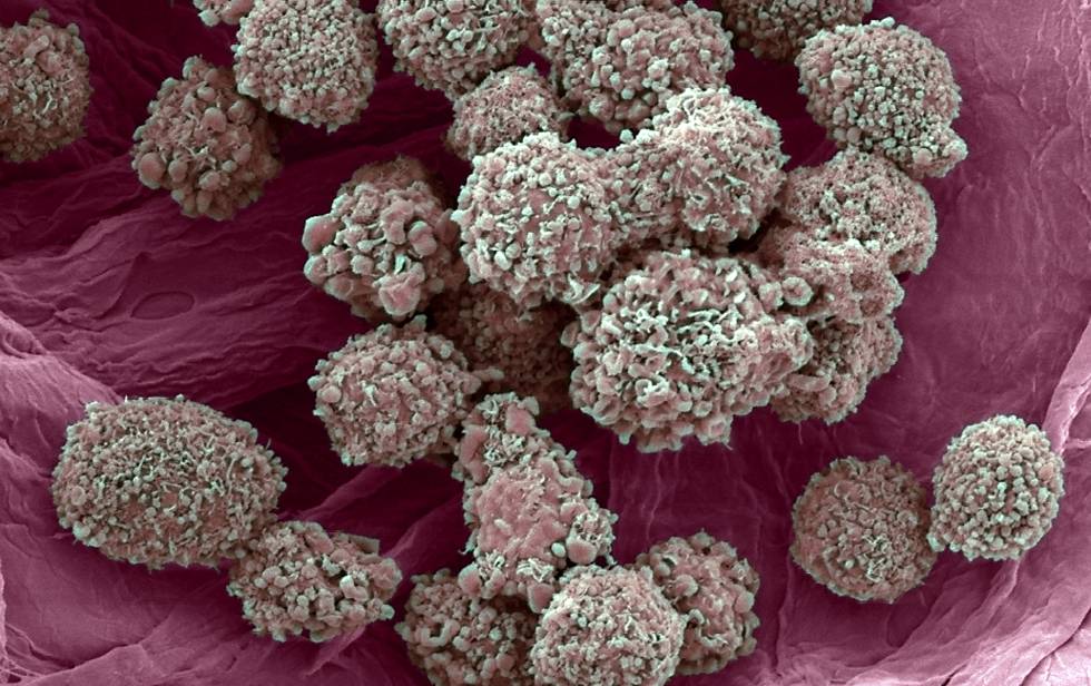 QUIMIOTERAPIA: ¡ES LA GUERRA!