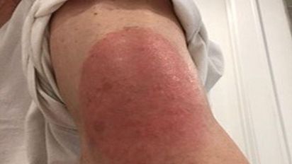 brazo covid 2