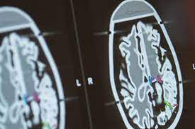 CEREBRO Y COVID2