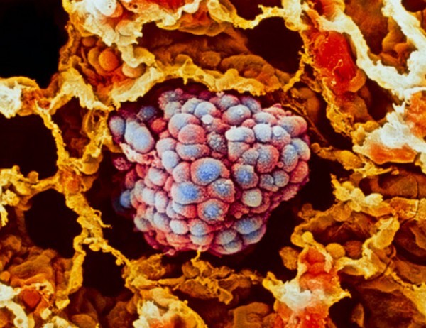 celulas cancer globulos