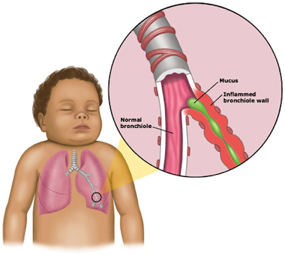 bronquiolitis infantil