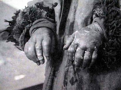 unit 731 frostbite