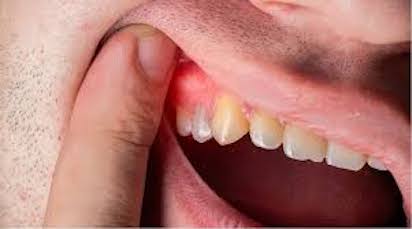 IMPLANTES 4