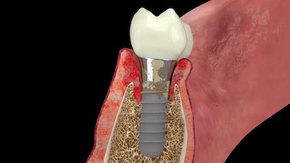 implantes 2