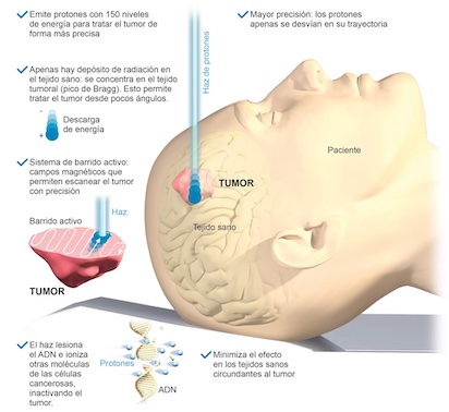 ventajas protonterapia