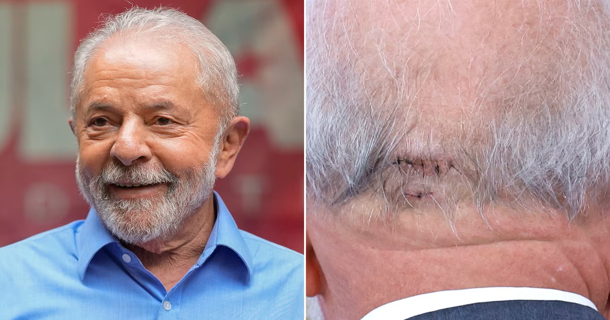 LULA DA SILVA, OPERADO DE URGENCIA POR HEMORRAGIA INTRACEREBRAL