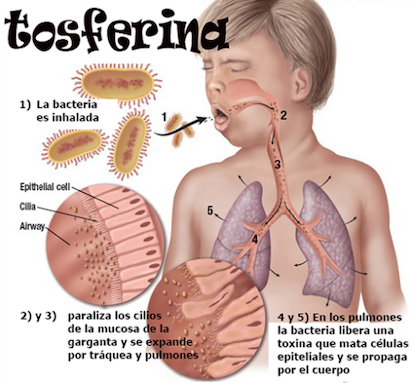 TOSFERINA