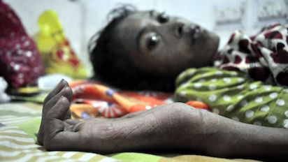 TUBERCULOSIS: LA PRINCIPAL PANDEMIA DEL MUNDO