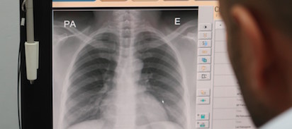 X ray tuberculosis